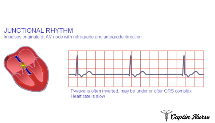 Junctional rhythm 원인과 EKG 특징 그리고 Junctional rhythm 치료 방법은? : 네이버 블로그