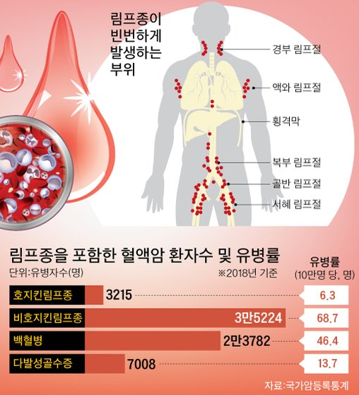 림프종 : 종류, 원인, 증상, 진단방법, 치료방법 : 네이버 블로그