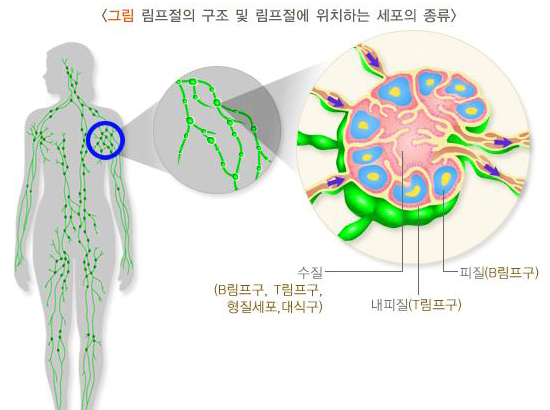 림프종 : 종류, 원인, 증상, 진단방법, 치료방법 : 네이버 블로그
