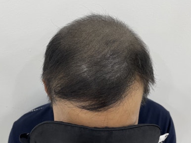 림스칼프 이미지
