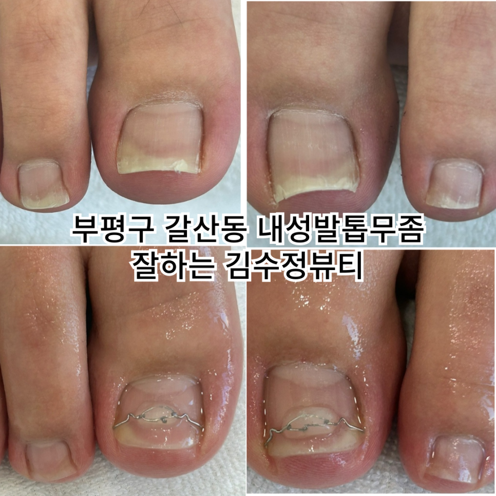 내성발톱발톱무좀관리김수정뷰티 이미지