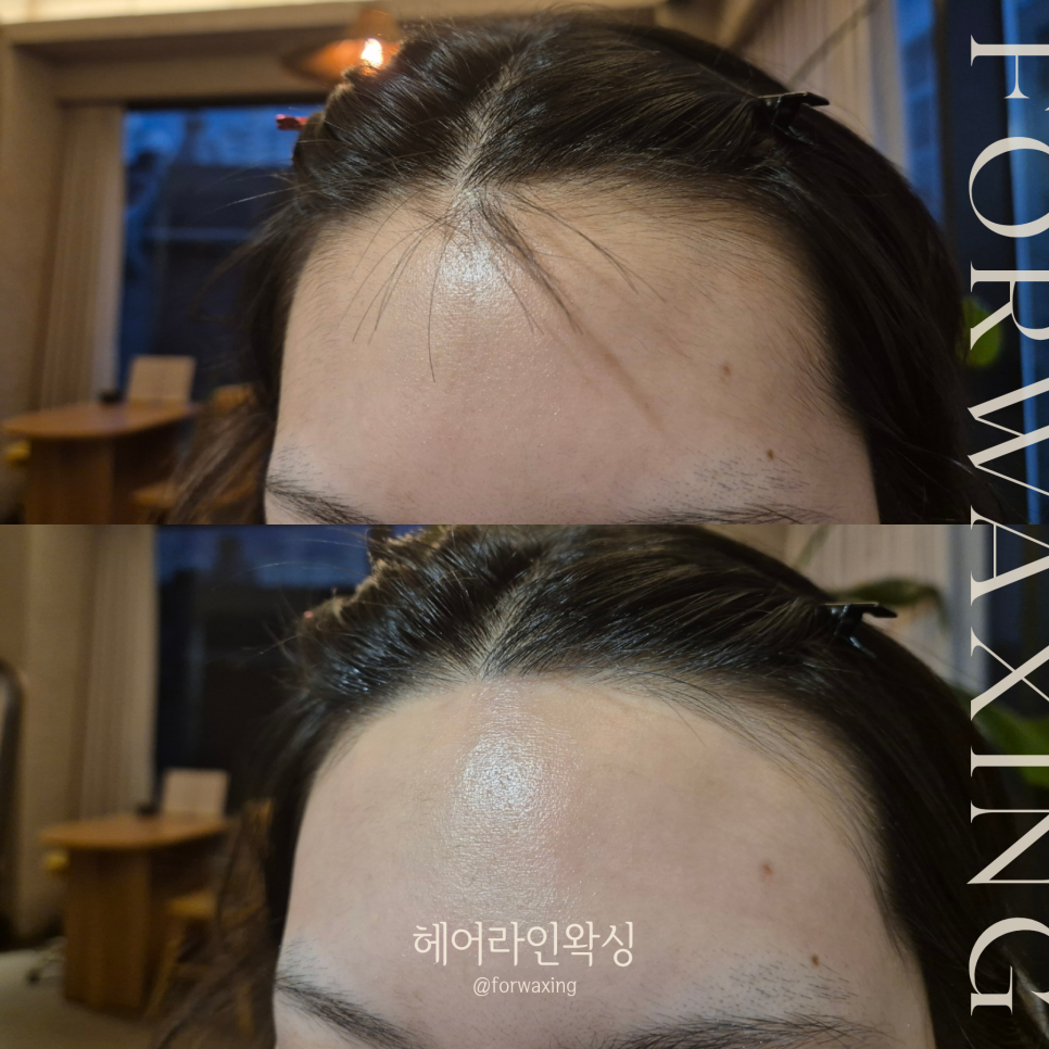 현헤어라인 이미지