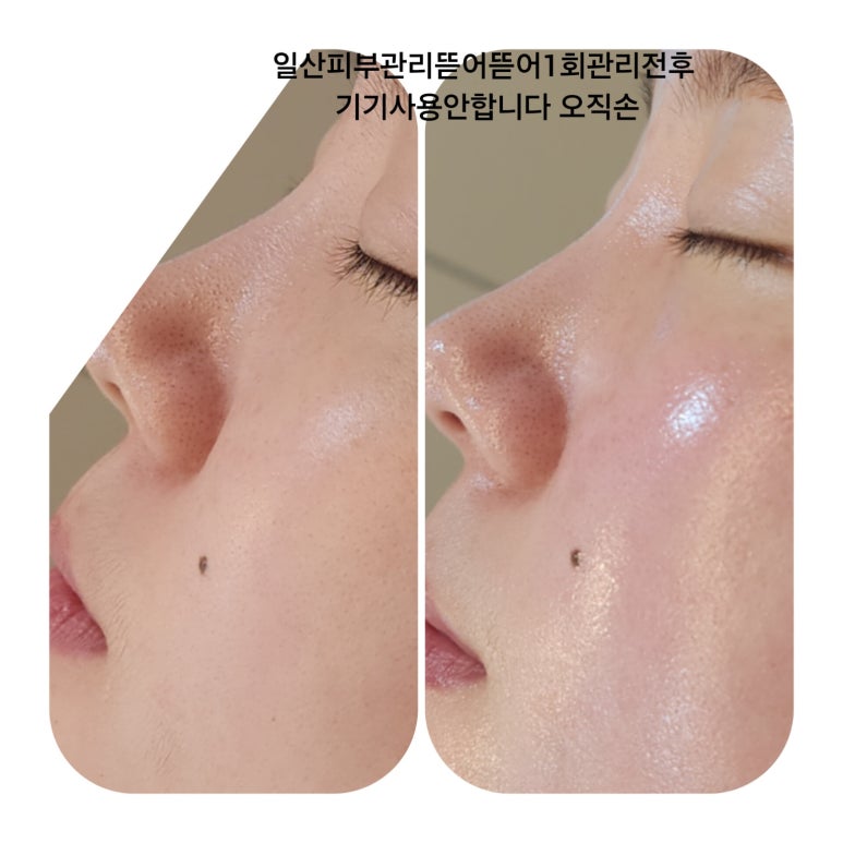 김숙피부 이미지