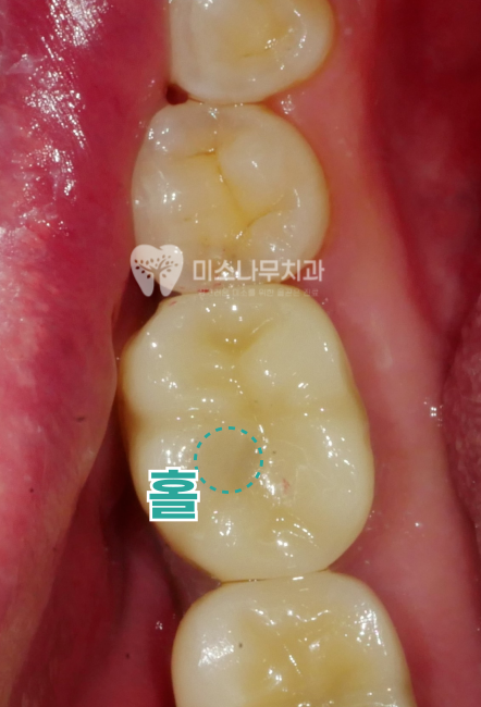 치아 사진