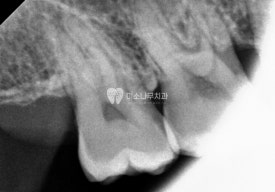 치아 엑스레이 사진