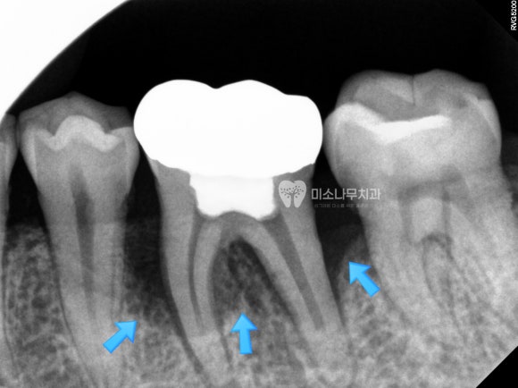 잇몸 뿌리 엑스레이 사진