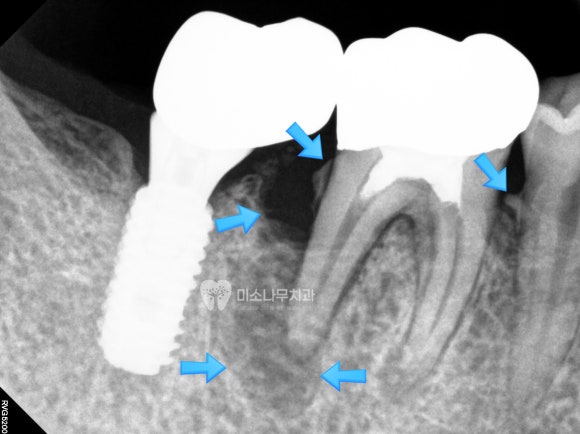 잇몸 뿌리 엑스레이 사진