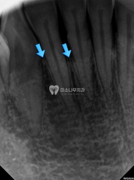 치아 엑스레이 사진