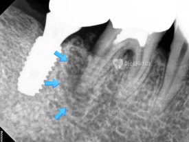 치아 엑스레이 사진