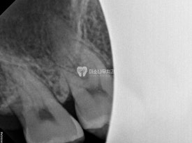 치아 엑스레이 사진