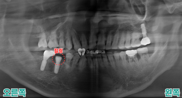 치아 엑스레이 사진