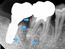 치아 엑스레이 사진