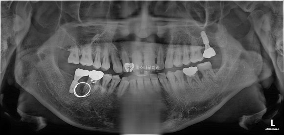 치아 엑스레이 사진