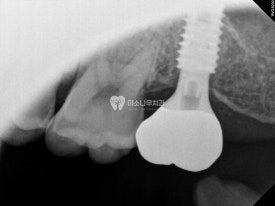 치아 엑스레이 사진