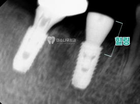 치아 엑스레이 사진