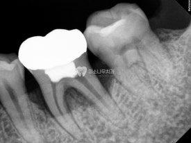 치아 엑스레이 사진