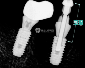 치아 엑스레이 사진