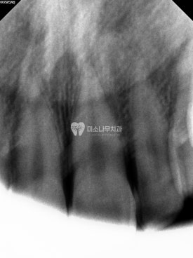 치아 엑스레이 사진