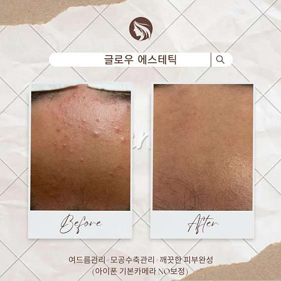 글로우에스테틱 이미지