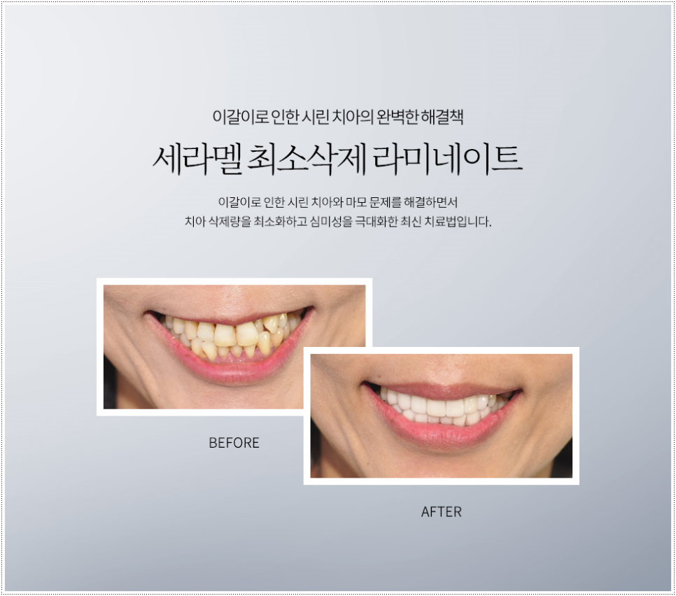 세라덴토 이미지