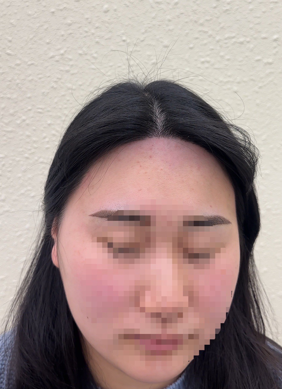 모모헤어라인 이미지