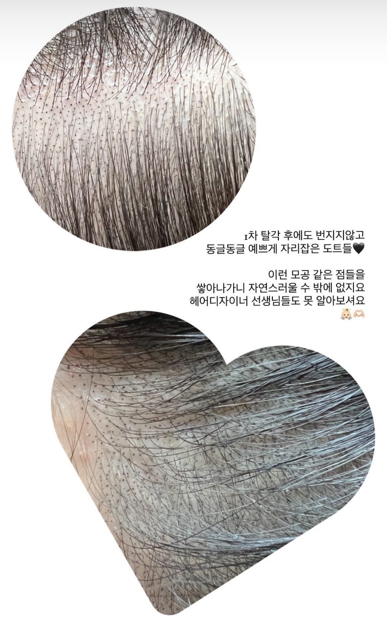 매직헤어라인 이미지