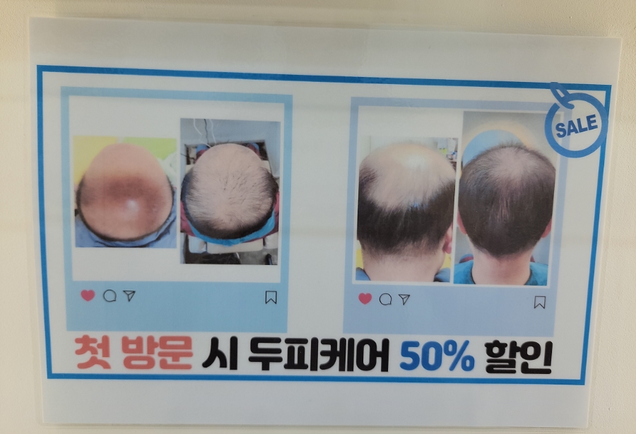 태후사랑머리염색두피 이미지