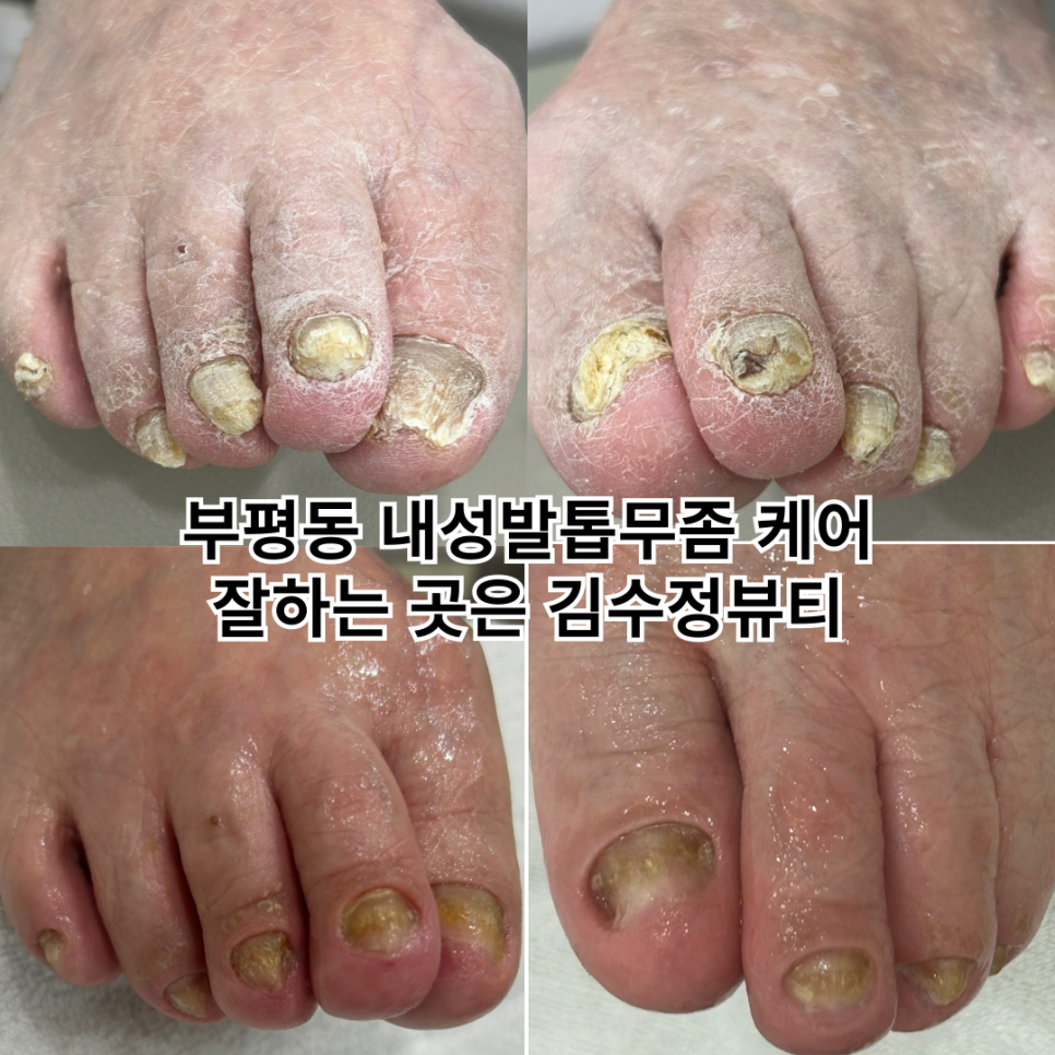 내성발톱발톱무좀관리김수정뷰티 이미지