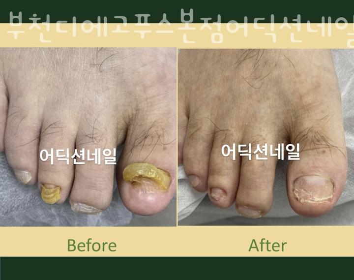 부천디에고푸스본점어딕션네일&풋케어전문 이미지