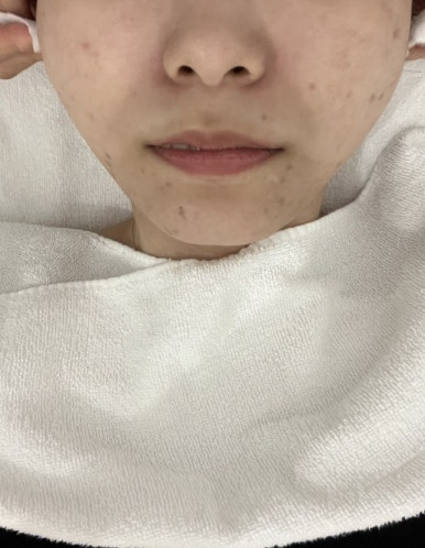 아누보스킨 이미지