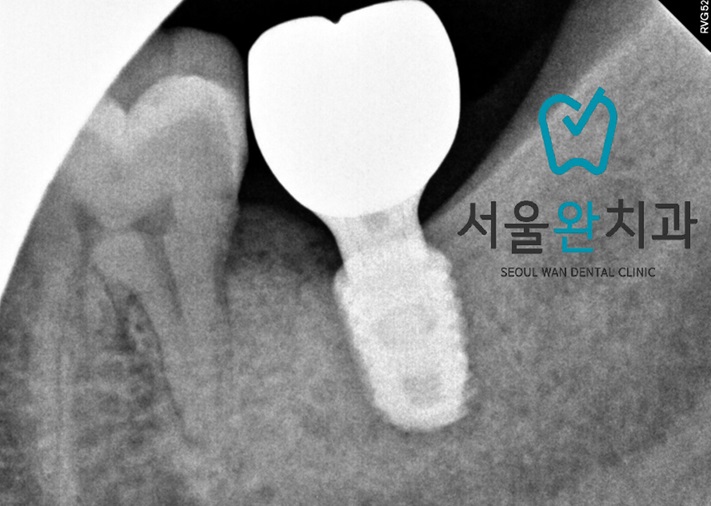 서울완치과 이미지