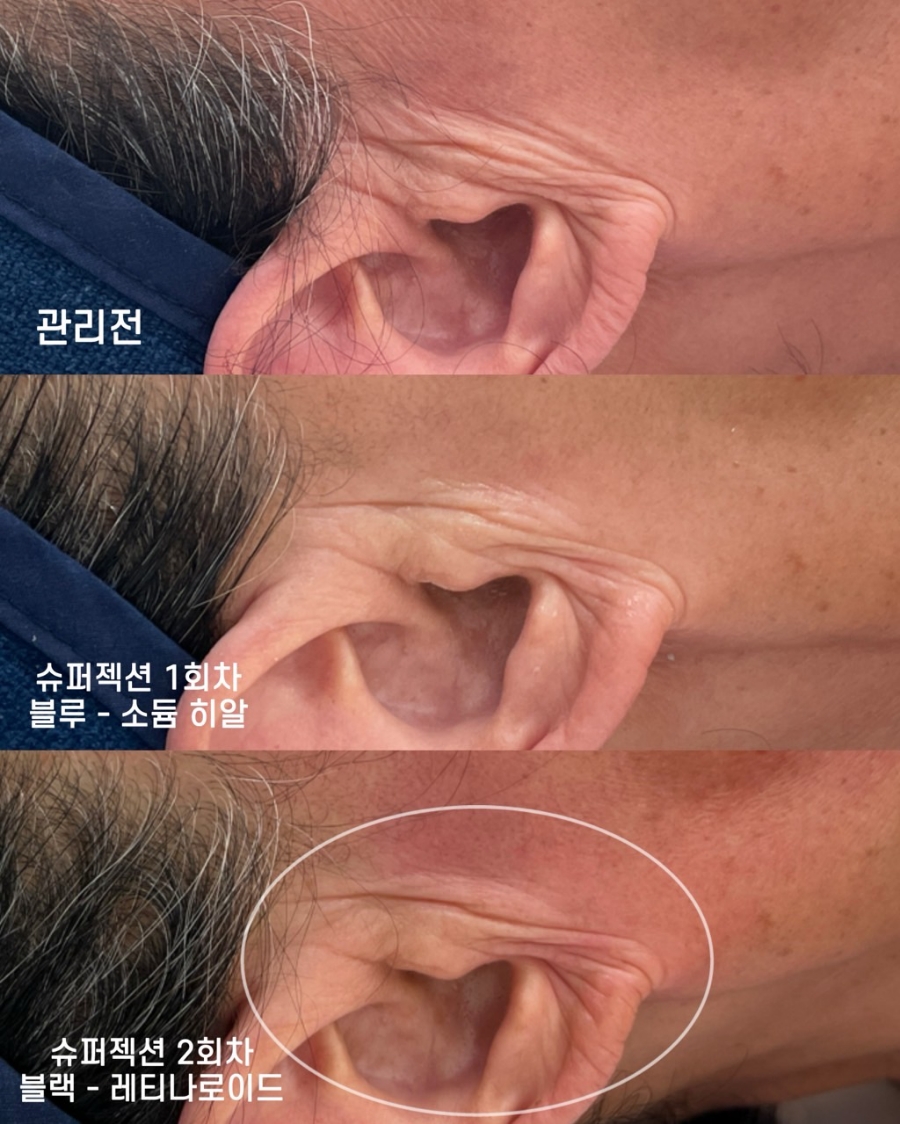 쁘에르 이미지