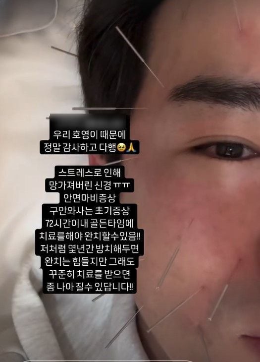안면가스 이미지