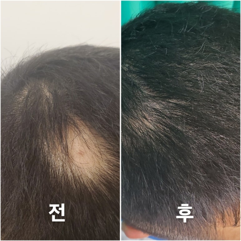 숲칼프가산두피탈모전문센터 이미지