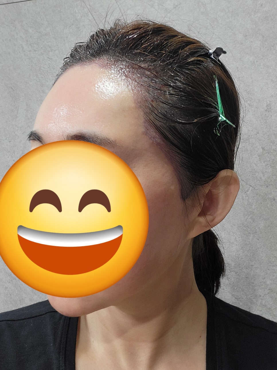 은혜헤어라인 이미지