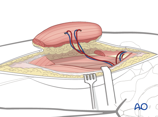 ALT flap (AnteroLateral Thigh Flap) - 유리피판술(Free flap) 요약 정리 : 네이버 블로그