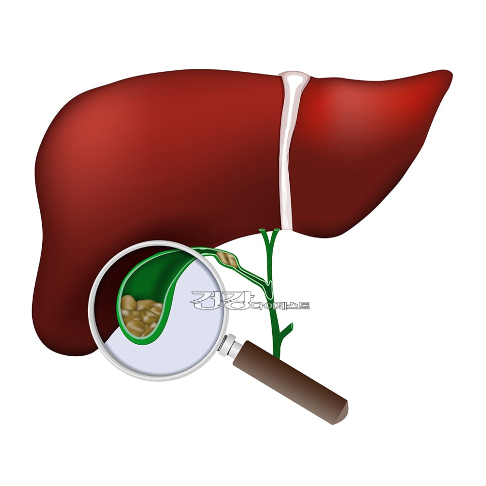 [췌장담도내시경 시술] 수술없이 담석을 제거 하는 ERCP : 네이버 블로그