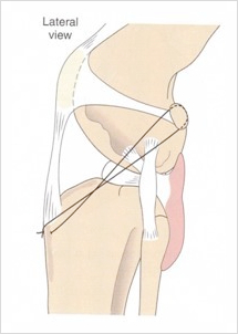 스피츠 전십자인대 단열 TPLO 수술 비용 및 회복 과정 — 사진 4