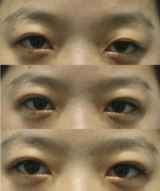 [부산자연유착쌍꺼풀] 쌍꺼풀 라인이 오래가는 조건, 성형외과전문의 기준 분석 : 네이버 블로그