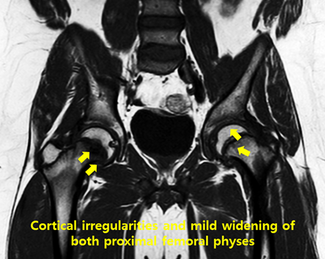 Case Review_73-14세 절름발이 소년-Slipped capital femoral epiphysis (SCFE-대퇴골두 ...