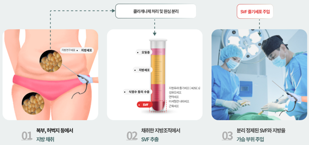 image 보형물 제거 후 자연스러운 가슴을 원한다면? SVF 가슴성형(줄기세포 가슴성형)