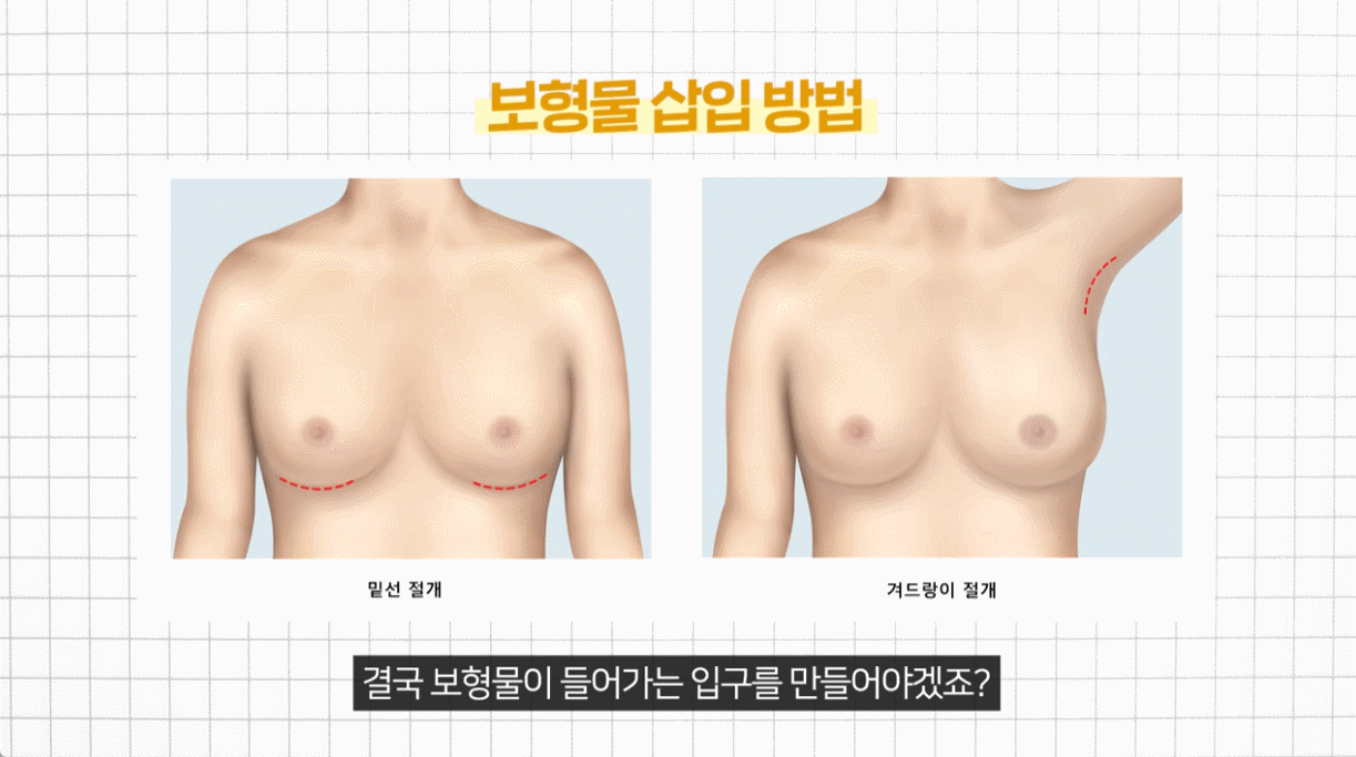 %EC%A0%88%EA%B0%9C%ED%9D%89%ED%84%B0 보형물 제거 후 자연스러운 가슴을 원한다면? SVF 가슴성형(줄기세포 가슴성형)