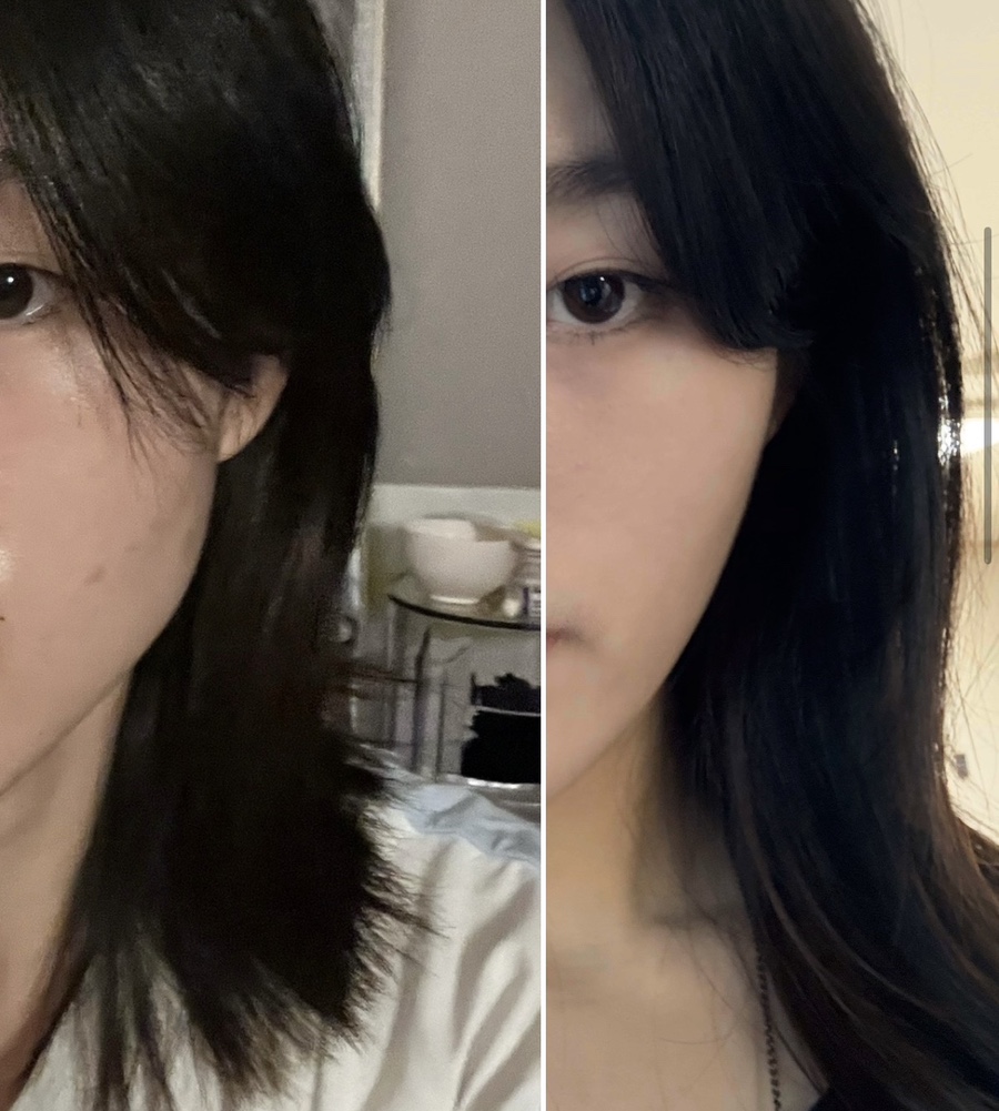 내돈내산 수술 사각턱 보톡스 가장 효과보는 얼굴 특징 부작용까지 솔직정리 : 네이버 블로그