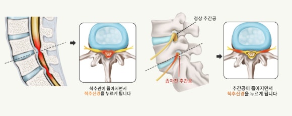 익산바른몸한의원 블로그 본문 이미지