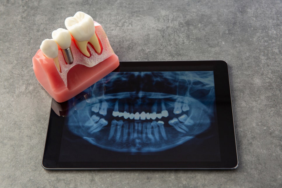 구래역임플란트 환자분들이 많이 하시는 질문은?