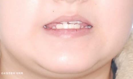 치아교합 불일치로 인한 반대교합 : 일산 성장기 1·2차 교정 증례