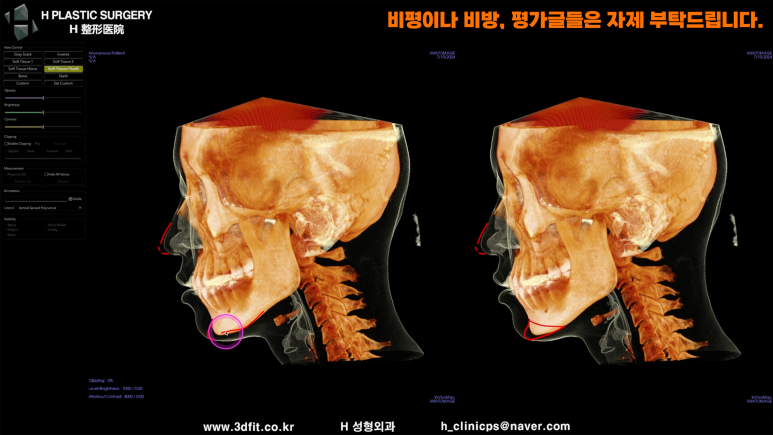 코 높이와 턱끝 전진을 함께 고려한 측면 얼굴 계획