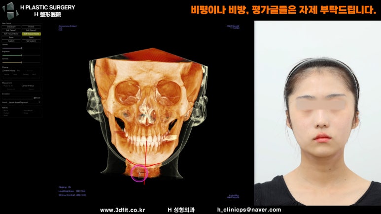 안면비대칭 개선을 위해 좌우 턱끝 길이를 다르게 계획한 이미지