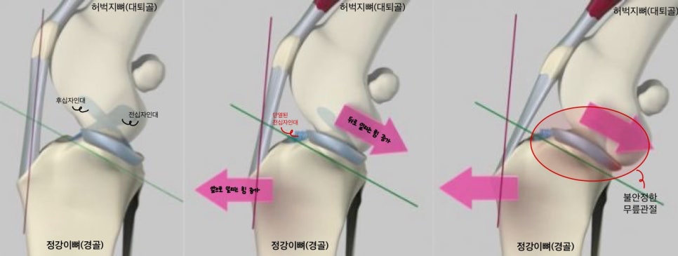 2살 강아지 십자인대 수술 후기: TPLO 성공 사례 — 사진 3
