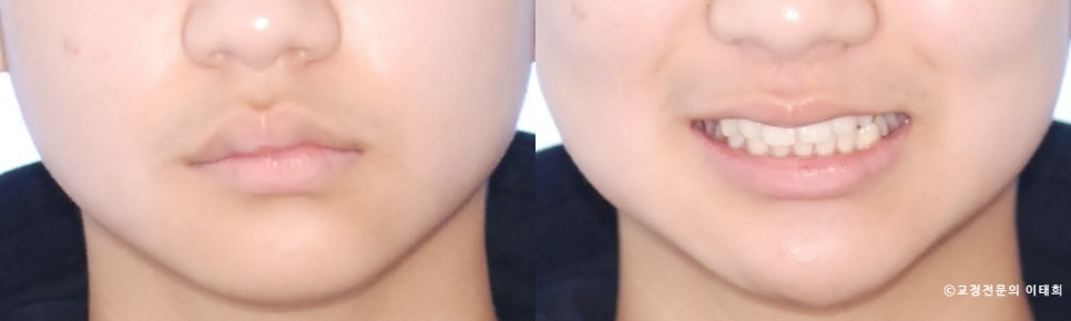 골격성 안면비대칭 일산 10대 환자, 교정으로 정중선과 반대교합을 개선한 증례